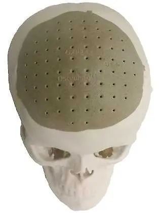 Присадиха принтиран в 3-D човешки череп с революционна операция