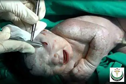 Бебе се роди с шрапнел в главата в Сирия