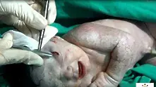 Бебе се роди с шрапнел в главата в Сирия