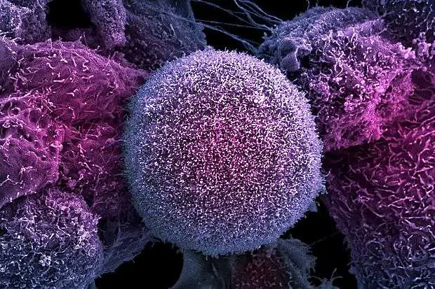 Учени: Ракът не е само лош късмет, зависи и от начина на живот
