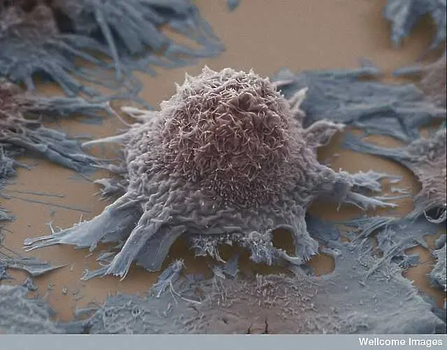 Лекари откриха ахилесовата пета на раковите клетки