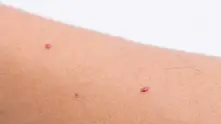 Какви са тези червени точки по кожата?