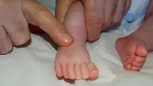 Оперираха успешно бебе с 24 пръста в Бургас