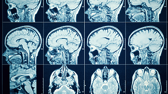 Невродегенеративни заболявания като Алцхаймер Паркинсон и Хънтингтън възникват когато невроните