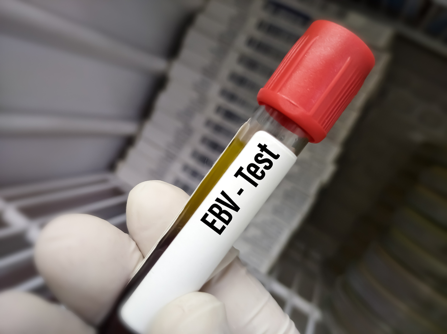 Учени от Станфорд: Често срещан вирус може да отключи лупус