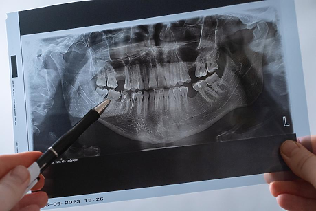 21-годишно проучване свързва пародонтозата и кариесите с повишен риск от инсулт