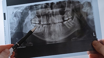 Доброто орално здраве отдавна се свързва с редица системни заболявания