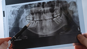 21-годишно проучване свързва пародонтозата и кариесите с повишен риск от инсулт