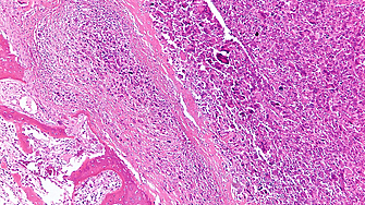Магнитни наночастици се борят с рака на костите и подпомагат възстановяването