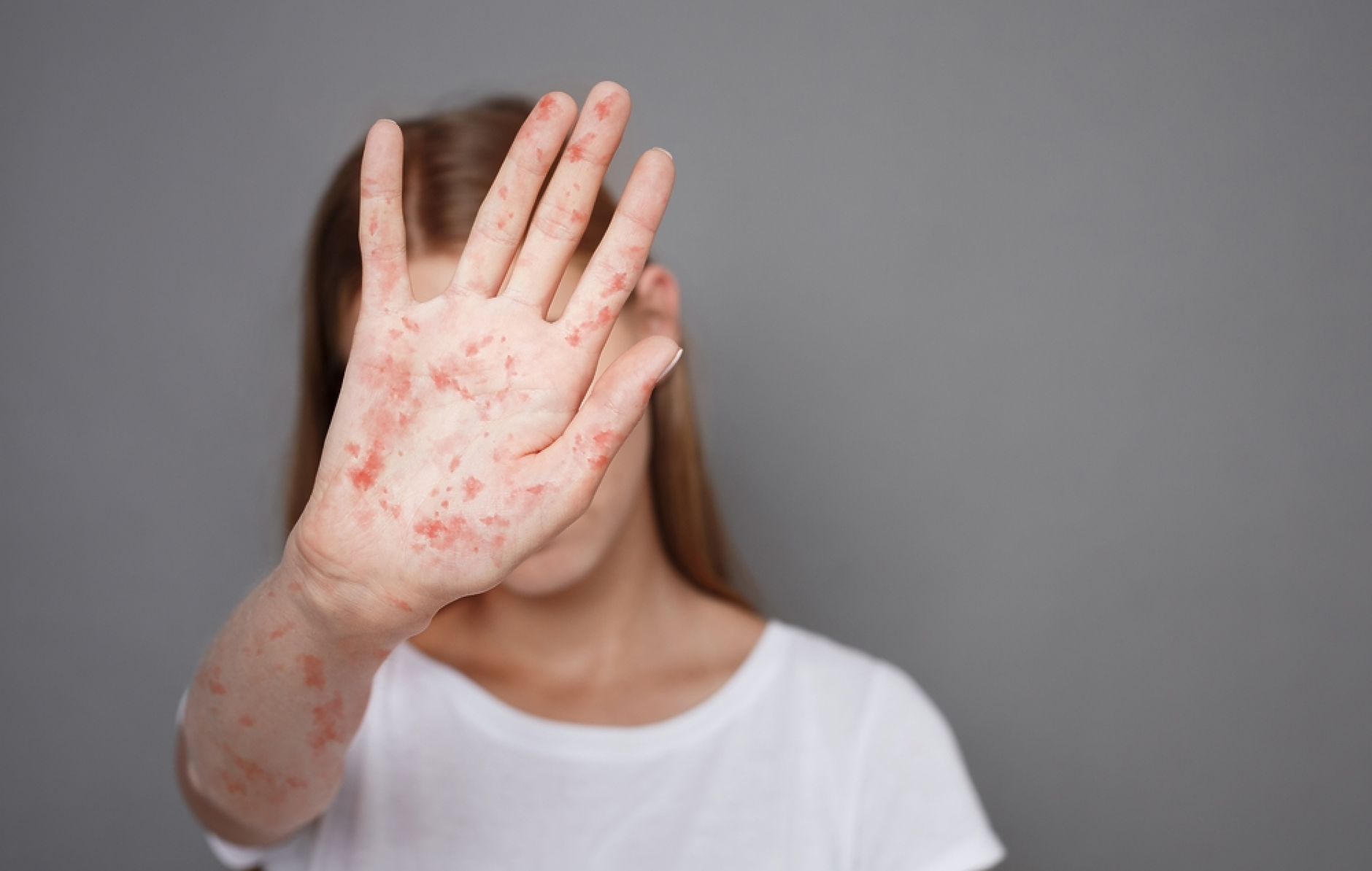 Общо 125 са случаите на морбили в страната